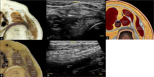 Rodilla posterior 2.jpg